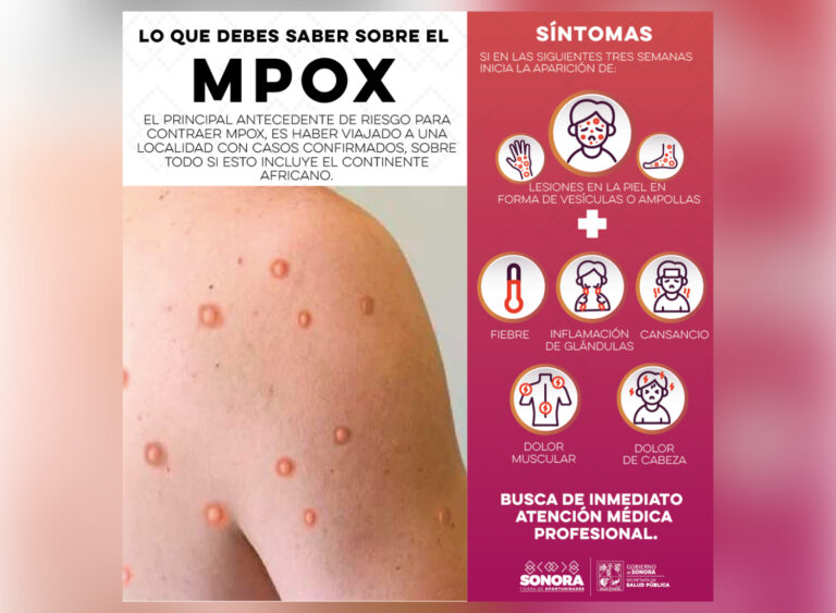 Salud Sonora confirma dos casos importados de MPOX; ambas personas no necesitaron hospitalización